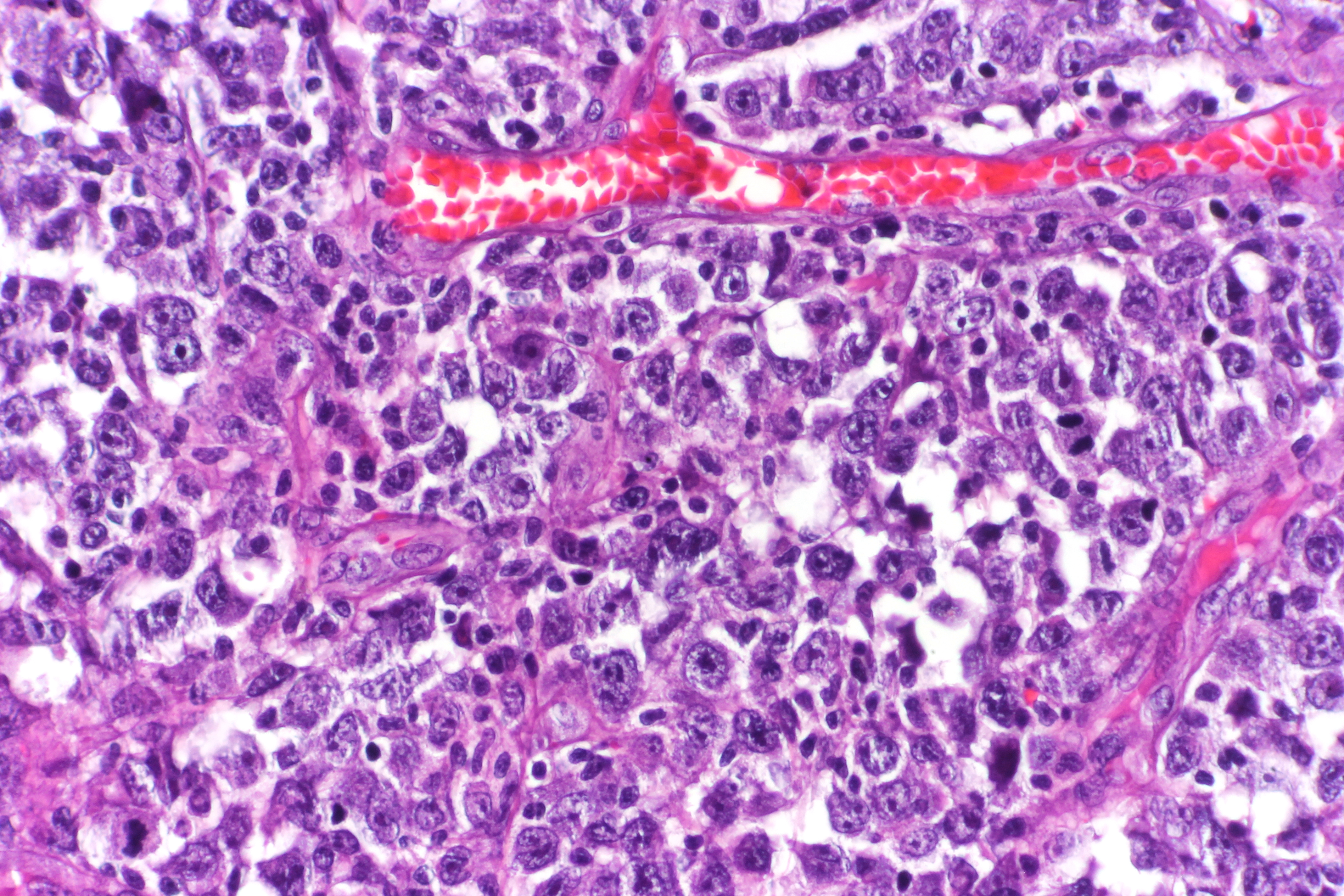 Diffuse Large B-Cell Lymphoma