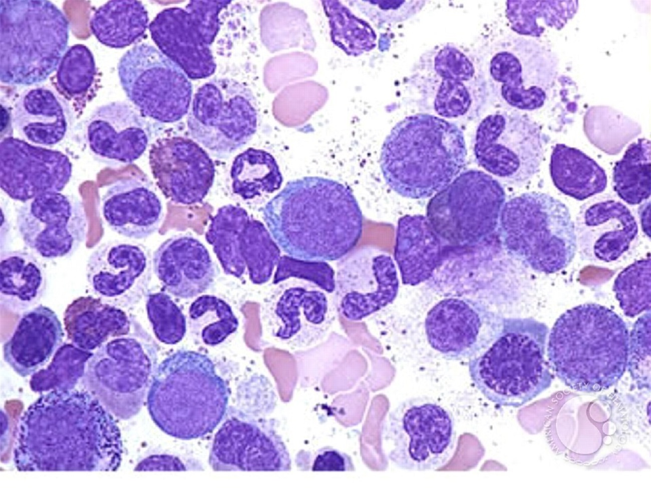 Chronic Myeloid Leukemia