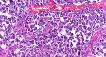 Diffuse Large B-Cell Lymphoma